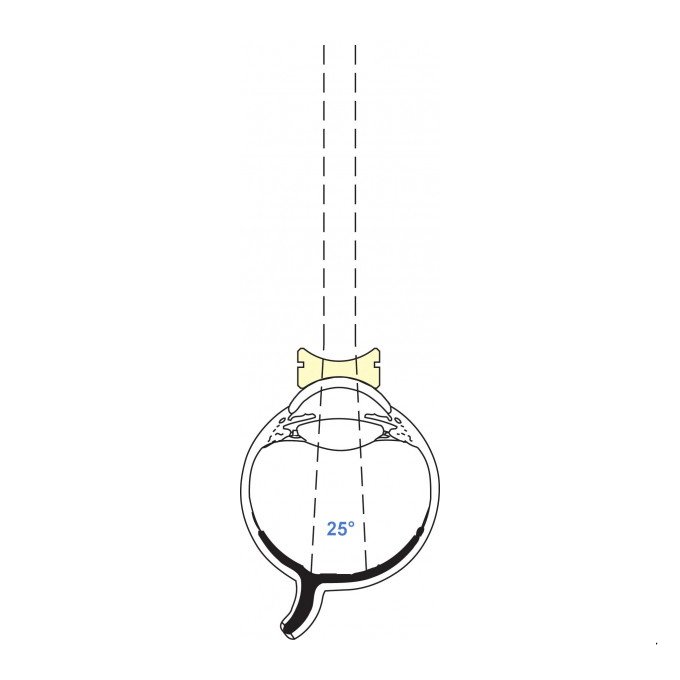 Lente pediatrica biconcava 92D Vitrectomia