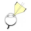 Lente di Ritch per suture nylon