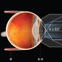 Lente Volk Laser 4 specchi No-Fluid