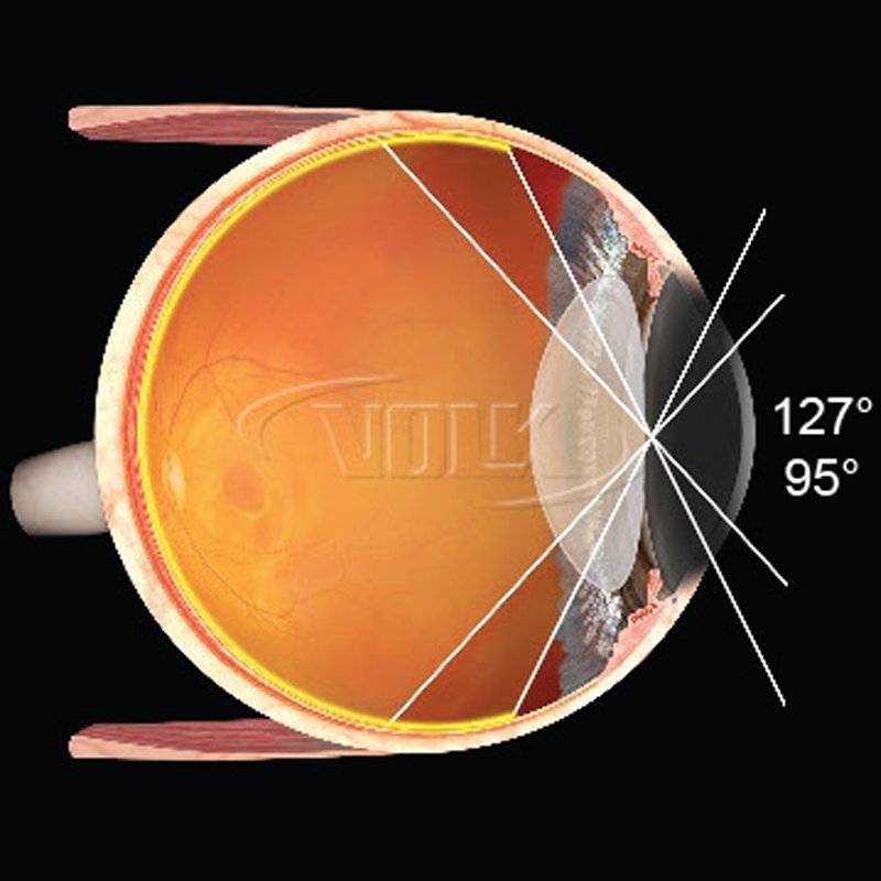 Lente per vitrectomia 156 DynaView
